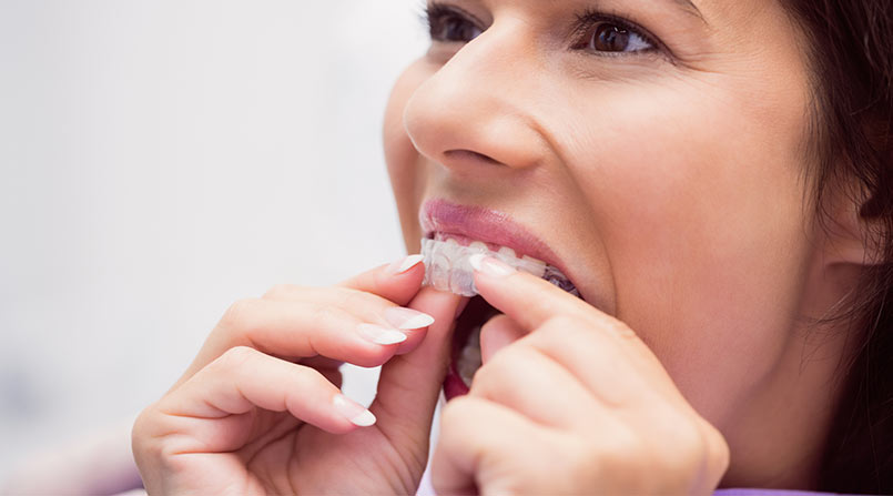 Como Corrigir os Dentes sem Aparelho