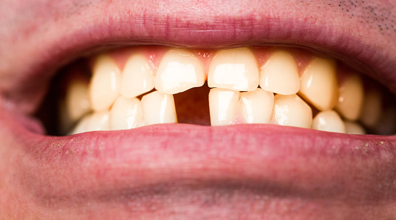 Perdi um dente e agora? Implante dentário como solução definitiva